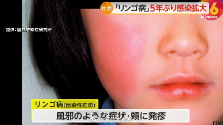 什么是苹果病?专家称苹果病危重症率和致死率极低 什么是苹果病?专家称苹果病危重症率和致死率极低