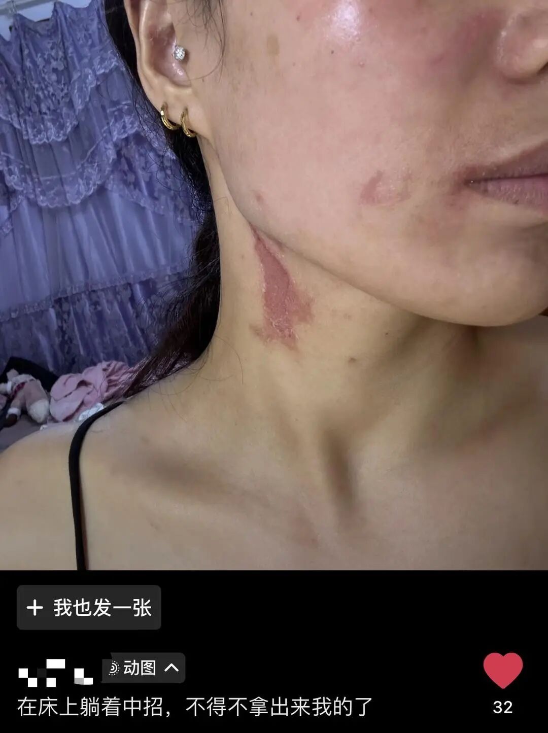 警惕“飞行的硫酸”！济南多人遭隐翅虫袭击