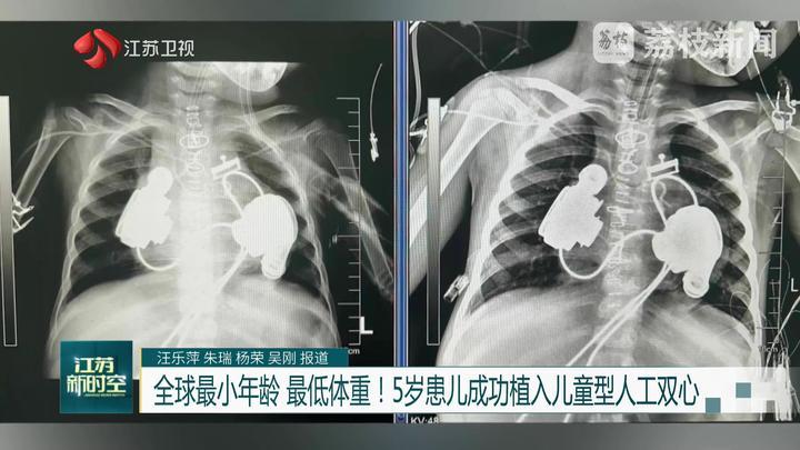 全球最小年龄 最低体重！5岁患儿成功植入儿童型人工双心