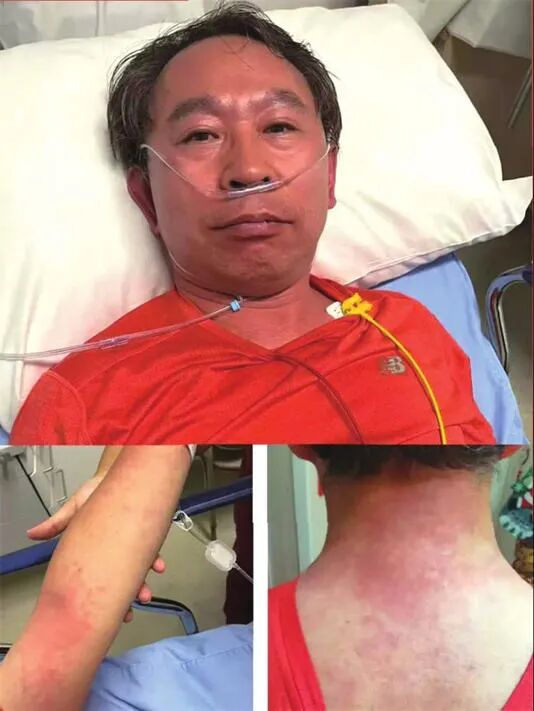 “以前不过敏，没喝酒”，协和专家吃头孢遇险！头孢还能吃吗？华山专家这样说