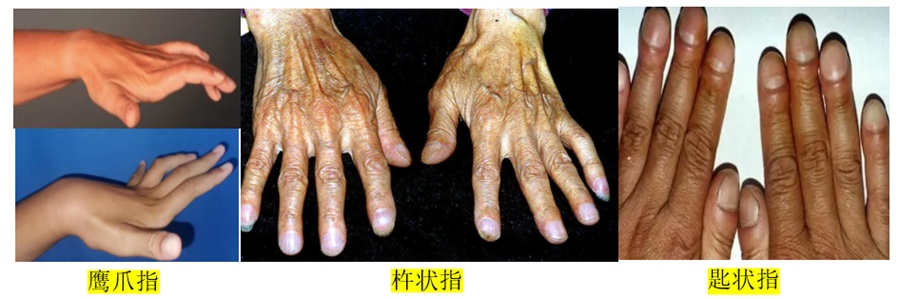 小小手指,竟暗藏大脑大小与健康的惊人秘密? 小小手指,竟暗藏大脑大小与健康的惊人秘密?