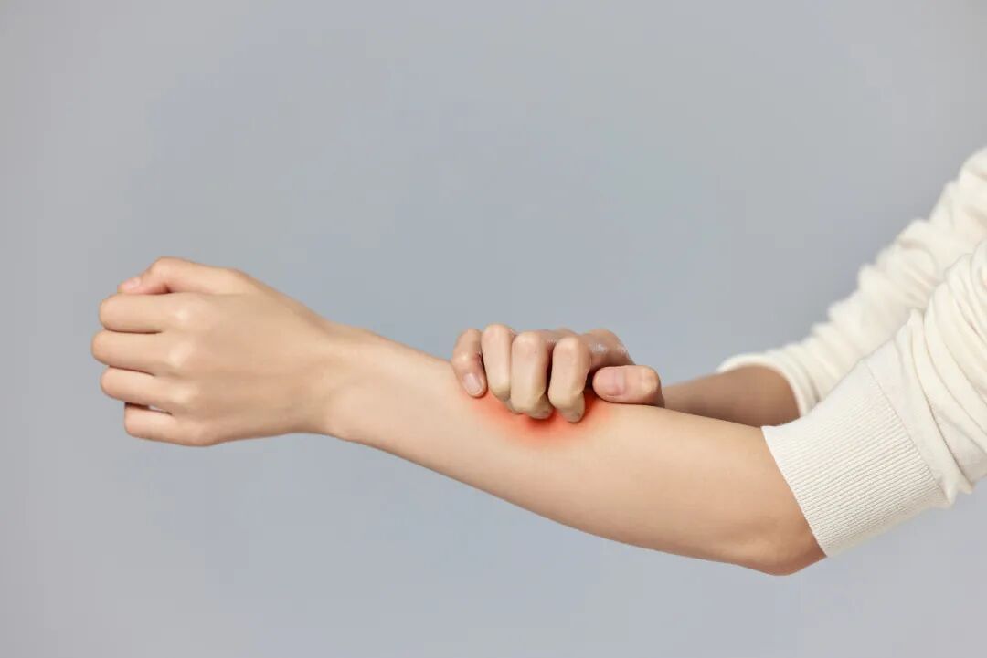 皮肤干燥、脱屑、瘙痒、皲裂……教您应对干燥性湿疹