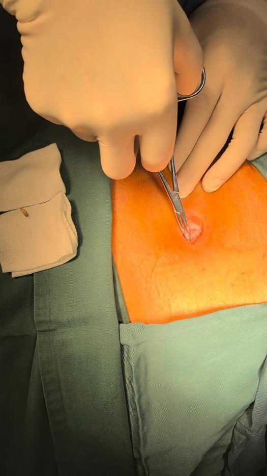 吓坏家人!七旬大爷被发现肚脐里有活蛆蠕动……专家:皮肤皱褶处易成为寄生虫“乐园” 吓坏家人!七旬大爷被发现肚脐里有活蛆蠕动……专家:皮肤皱褶处易成为寄生虫“乐园”