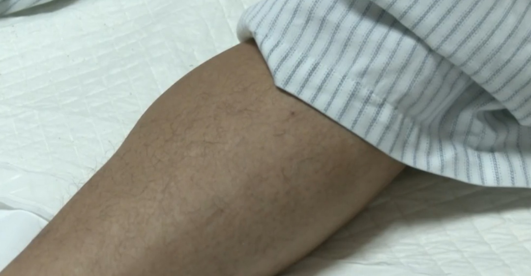 男子腿痛误当腰突,两周后脚趾变黑被迫截肢 男子腿痛误当腰突,两周后脚趾变黑被迫截肢