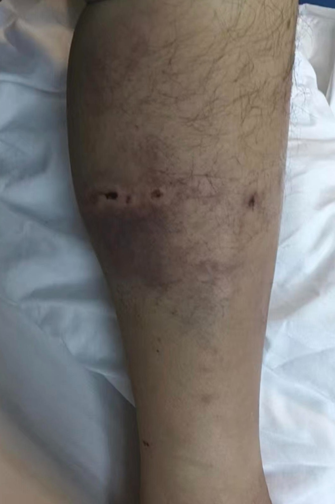 孕妇被熊猛啃脑袋,造成严重撕裂!秋季警惕“熊出没”! 孕妇被熊猛啃脑袋,造成严重撕裂!秋季警惕“熊出没”!