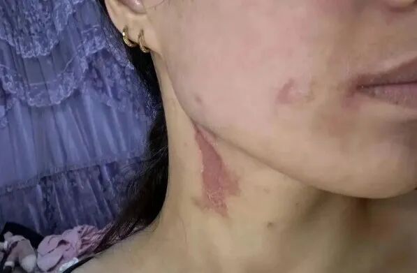 雨后大量出现！遇到这种虫，千万别拍！