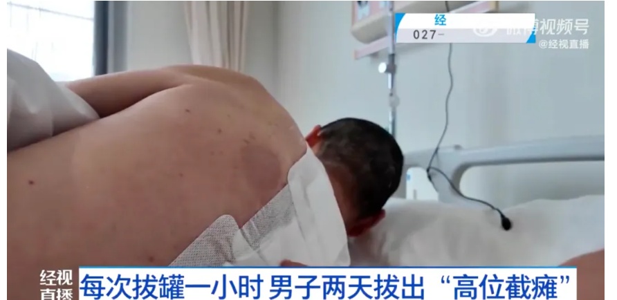 武汉一男子连拔2天火罐,突然高位截瘫!医生提醒→ 武汉一男子连拔2天火罐,突然高位截瘫!医生提醒→