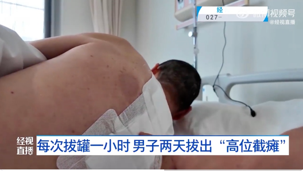 武汉一男子连拔2天火罐，突然高位截瘫！医生痛心提醒5个拔罐误区