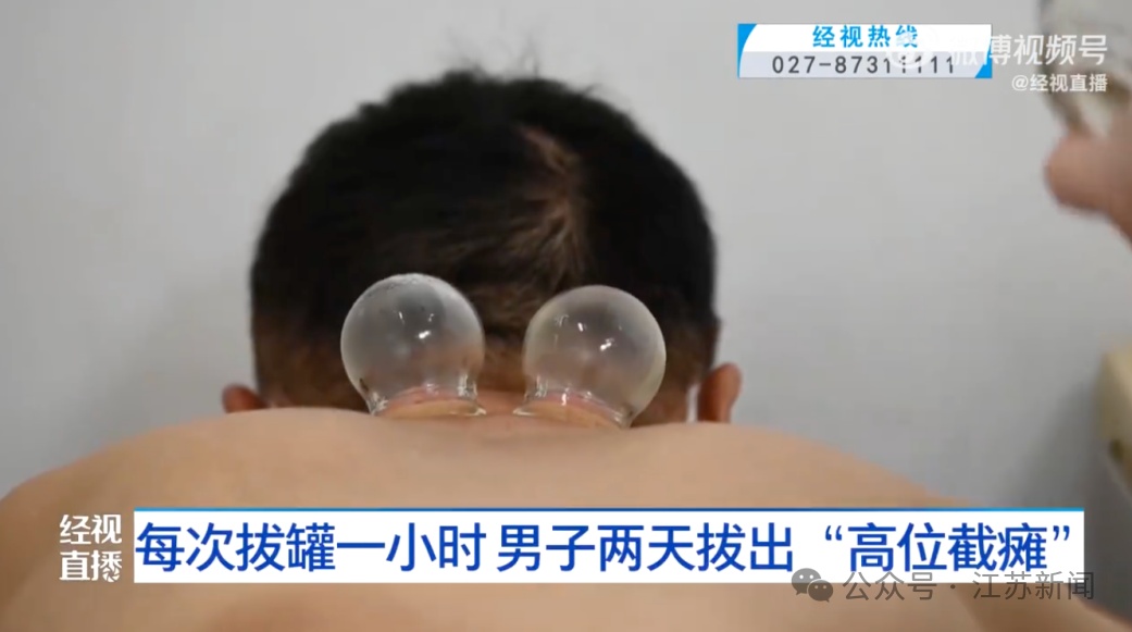 武汉一男子连拔2天火罐,突然高位截瘫!医生提醒→ 武汉一男子连拔2天火罐,突然高位截瘫!医生提醒→