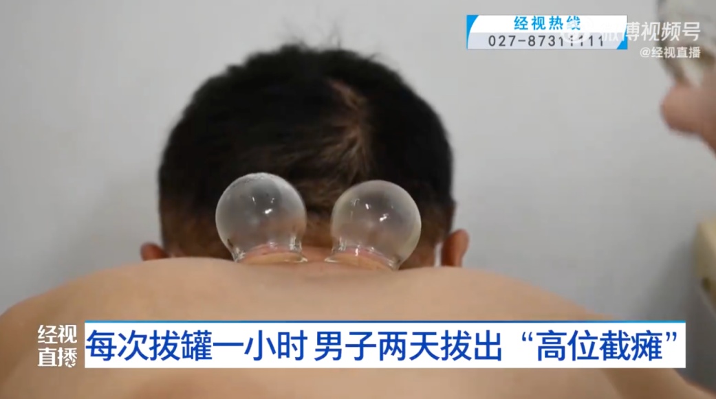 武汉一男子连拔2天火罐，突然高位截瘫！医生痛心提醒5个拔罐误区