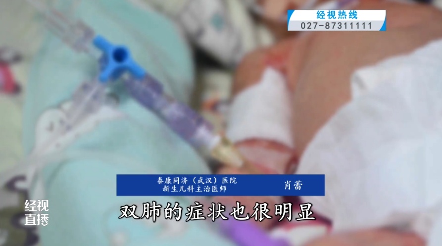 婴儿3天变重症,肺部症状集中爆发!这种病毒近期小心,再次提醒 婴儿3天变重症,肺部症状集中爆发!这种病毒近期小心,再次提醒
