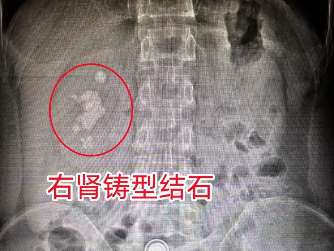 男子查出肾结石未重视，小结石“拖成”大麻烦