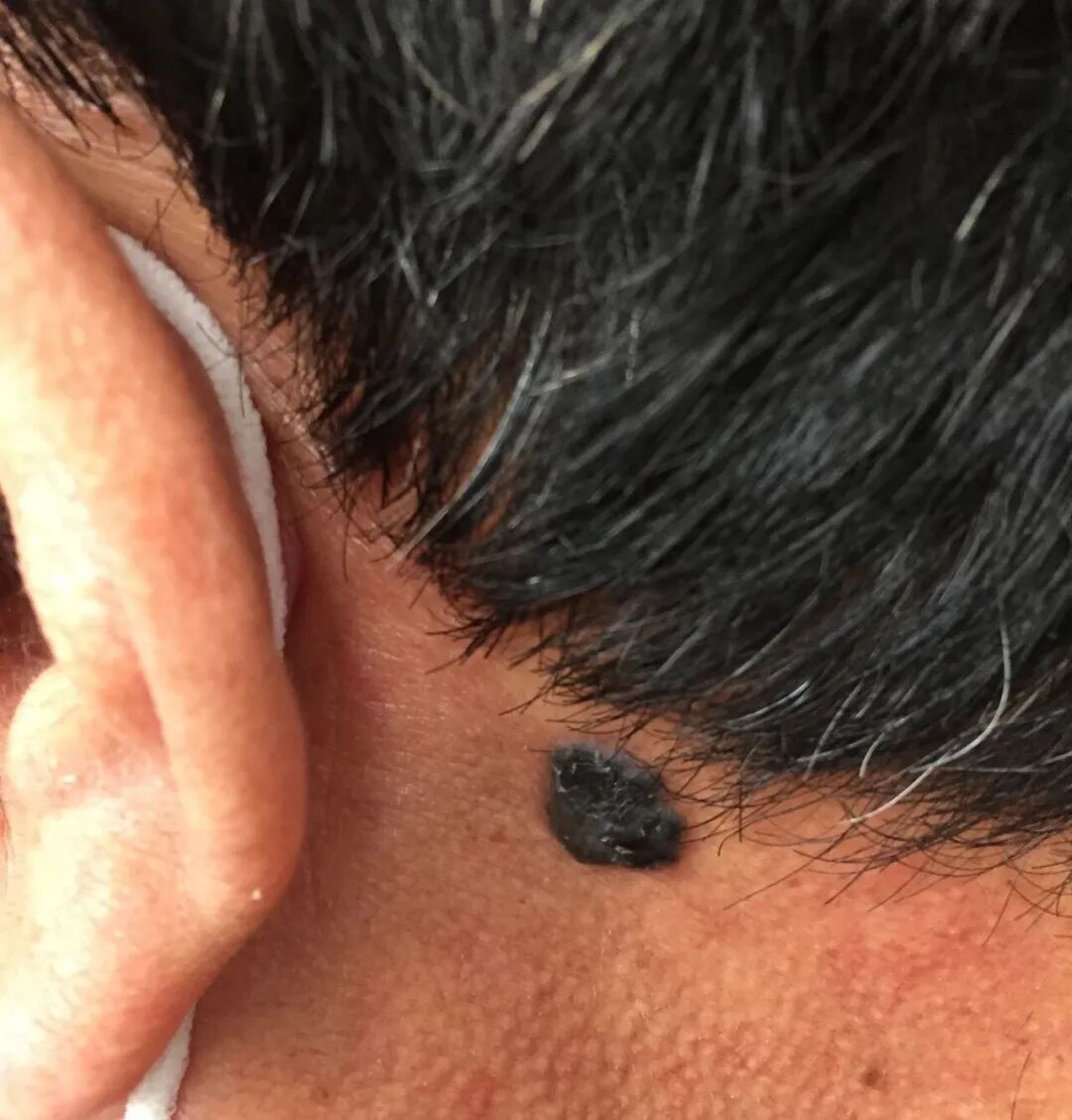 快看看你身上的痣,这颗“黑点”可能不是善茬! 快看看你身上的痣,这颗“黑点”可能不是善茬!
