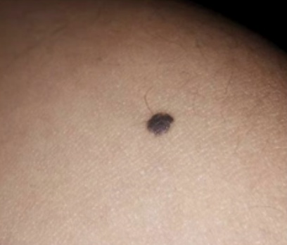 快看看你身上的痣,这颗“黑点”可能不是善茬! 快看看你身上的痣,这颗“黑点”可能不是善茬!