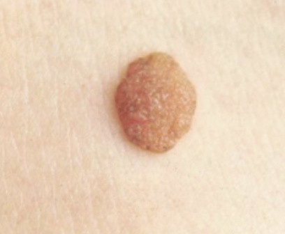 快看看你身上的痣,这颗“黑点”可能不是善茬! 快看看你身上的痣,这颗“黑点”可能不是善茬!