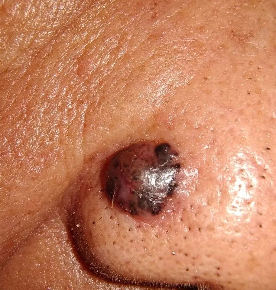 快看看你身上的痣,这颗“黑点”可能不是善茬! 快看看你身上的痣,这颗“黑点”可能不是善茬!