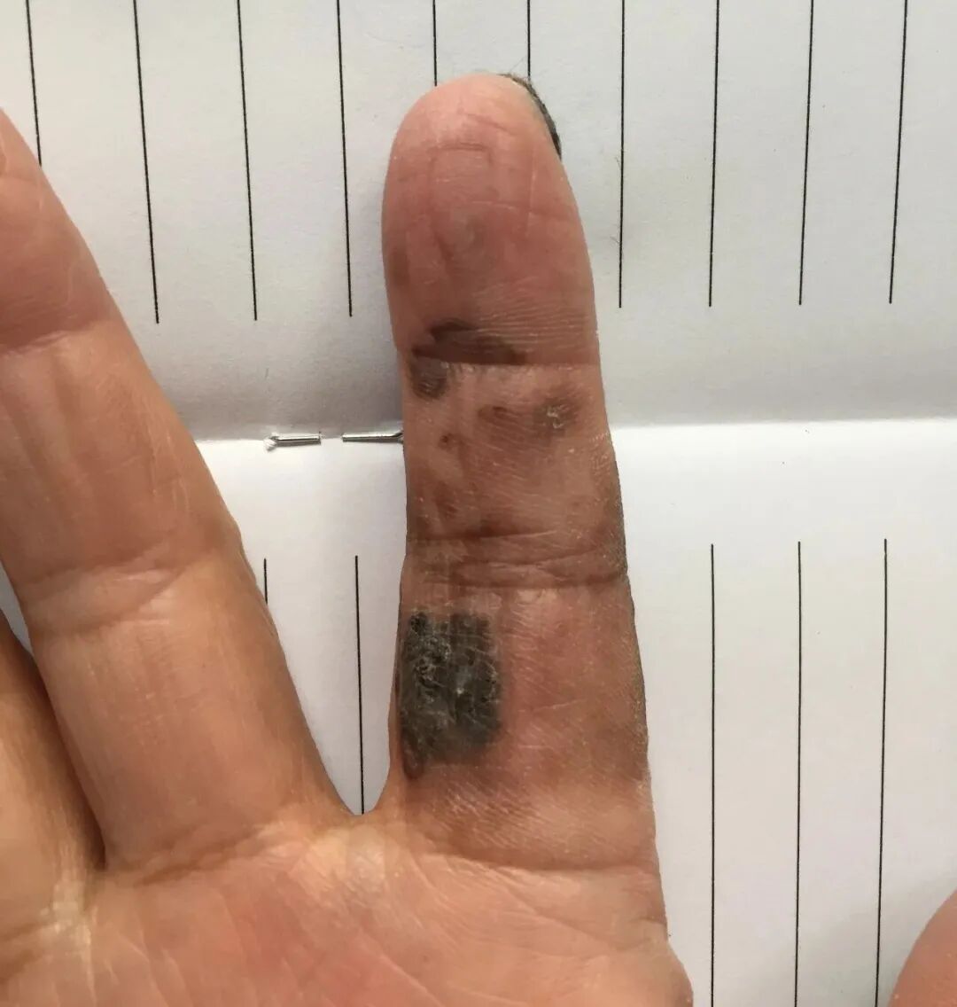 快看看你身上的痣,这颗“黑点”可能不是善茬! 快看看你身上的痣,这颗“黑点”可能不是善茬!