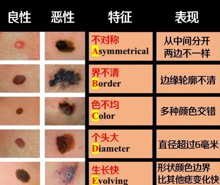 快看看你身上的痣,这颗“黑点”可能不是善茬! 快看看你身上的痣,这颗“黑点”可能不是善茬!