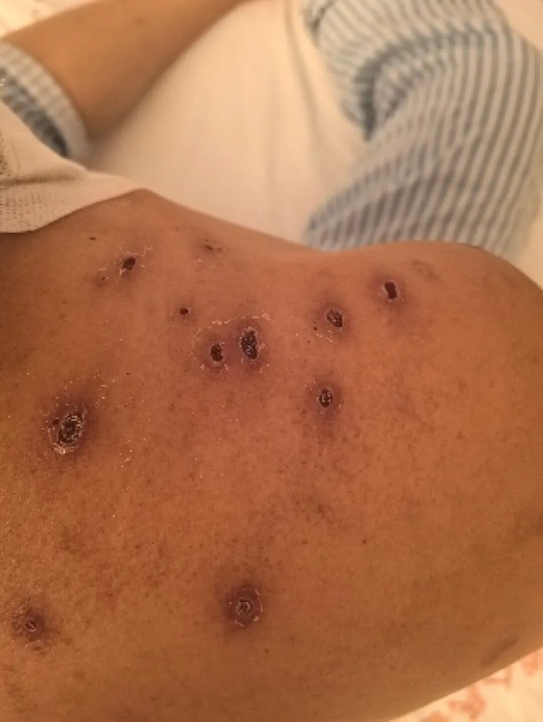 河南男子登山遭马蜂群袭，肾脏衰竭险丧命！医生紧急提醒