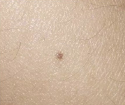 快看看你身上的痣,这颗“黑点”可能不是善茬! 快看看你身上的痣,这颗“黑点”可能不是善茬!