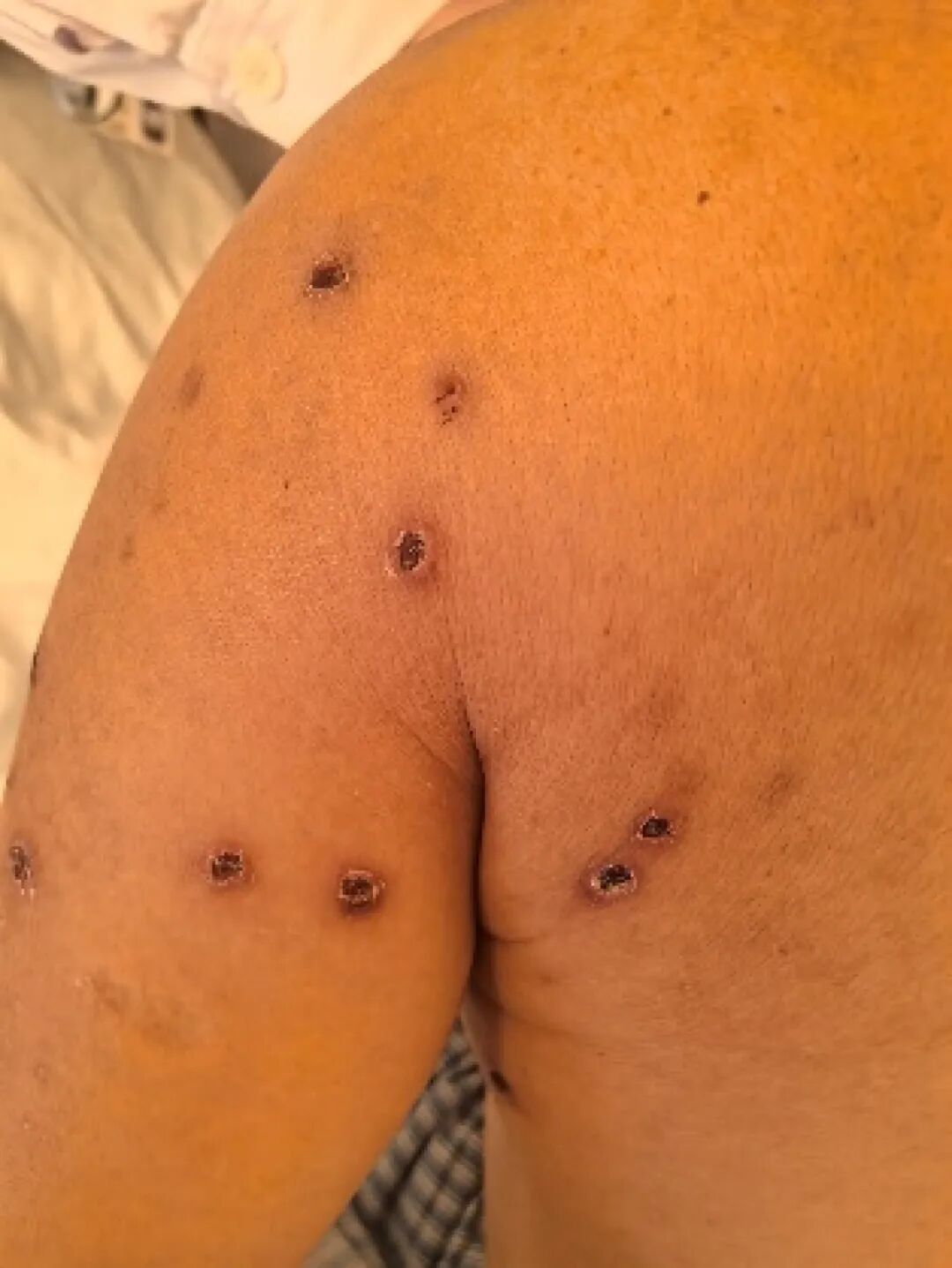 河南男子登山遭马蜂群袭，肾脏衰竭险丧命！医生紧急提醒