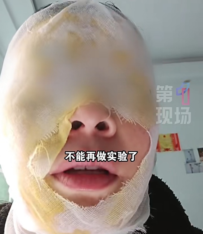 瞬间爆炸！脸被严重烫伤！女子给水壶除水垢，结果…