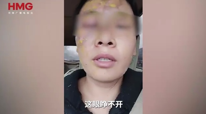 瞬间爆炸！女子模仿网络“妙招”：白糖加白醋烧开除水垢，脸被严重烫伤