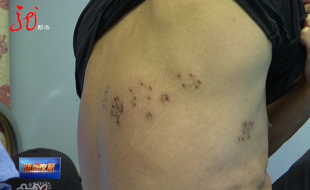 疼到彻夜难眠!这种 “蛇盘疮” 可能诱发心梗,警惕! 疼到彻夜难眠!这种 “蛇盘疮” 可能诱发心梗,警惕!