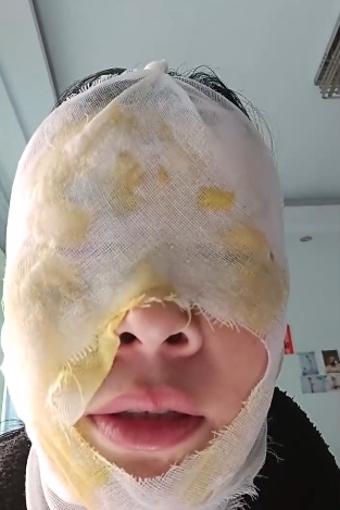 瞬间爆炸,女子脸部被严重烫伤!网友:我也差点信了 瞬间爆炸,女子脸部被严重烫伤!网友:我也差点信了