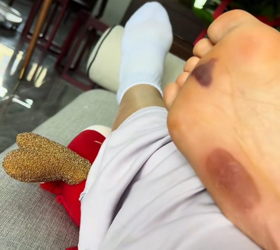 女子在家突然脚底喷血，紧急送医！这东西很多人在用……