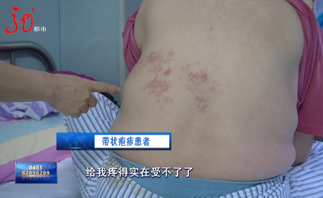 疼到彻夜难眠!这种 “蛇盘疮” 可能诱发心梗,警惕! 疼到彻夜难眠!这种 “蛇盘疮” 可能诱发心梗,警惕!
