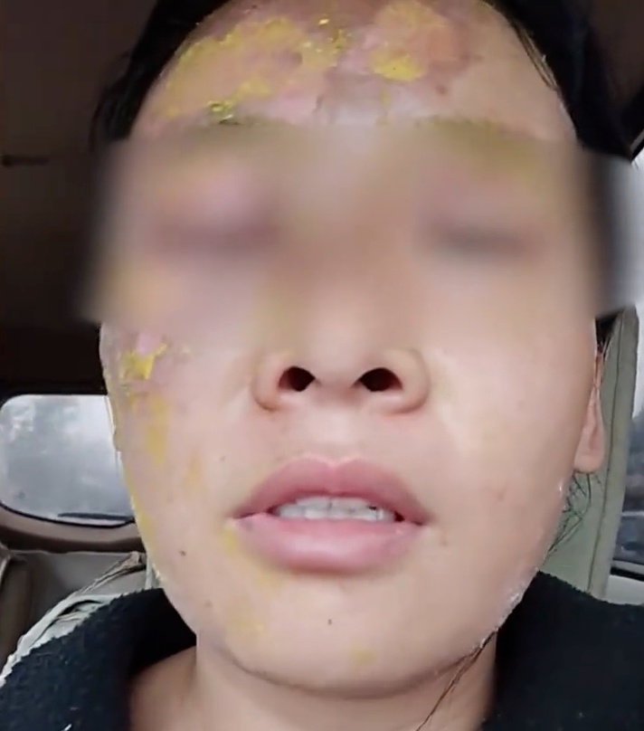 瞬间爆炸,女子脸部被严重烫伤!网友:我也差点信了 瞬间爆炸,女子脸部被严重烫伤!网友:我也差点信了