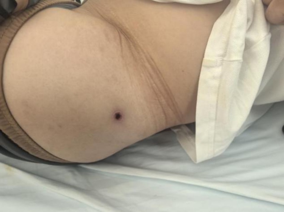 在海边被小虫叮咬,男子住进ICU!全国范围可见病例报告,暂无针对性疫苗 在海边被小虫叮咬,男子住进ICU!全国范围可见病例报告,暂无针对性疫苗