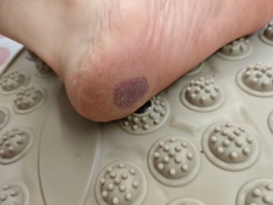 女子在家里突然脚底喷血！小心，这东西很多人在用