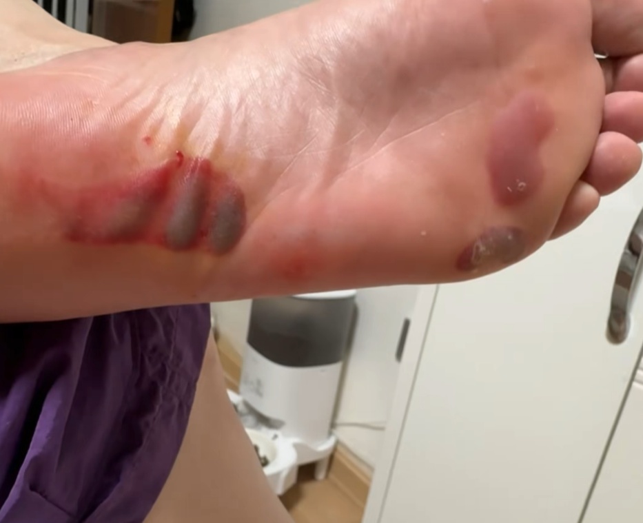 女子在家里突然脚底喷血！小心，这东西很多人在用