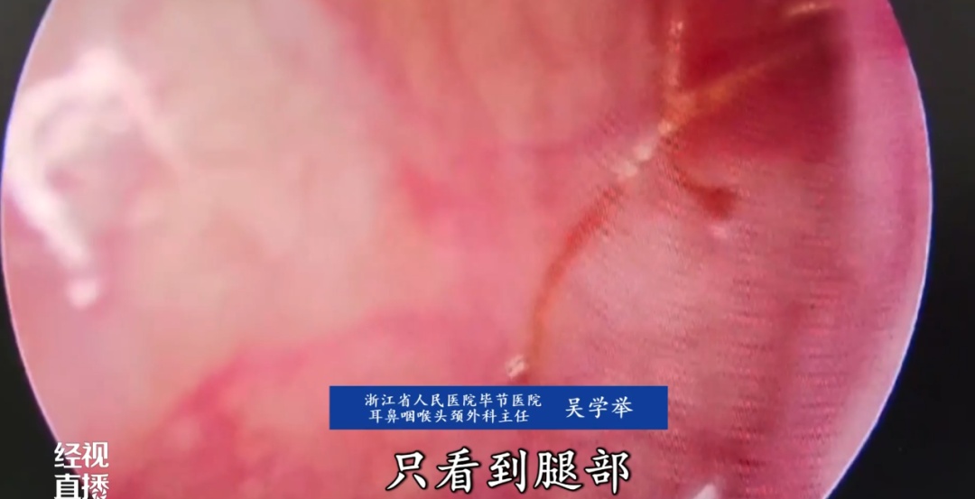 吓人！女子耳内突然钻心疼，医生取出四肢完整虫子……