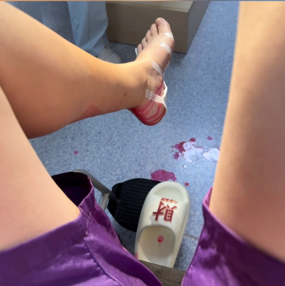 跟练20分钟,女子突然脚底“喷血”!这个网红运动产品很危险 跟练20分钟,女子突然脚底“喷血”!这个网红运动产品很危险