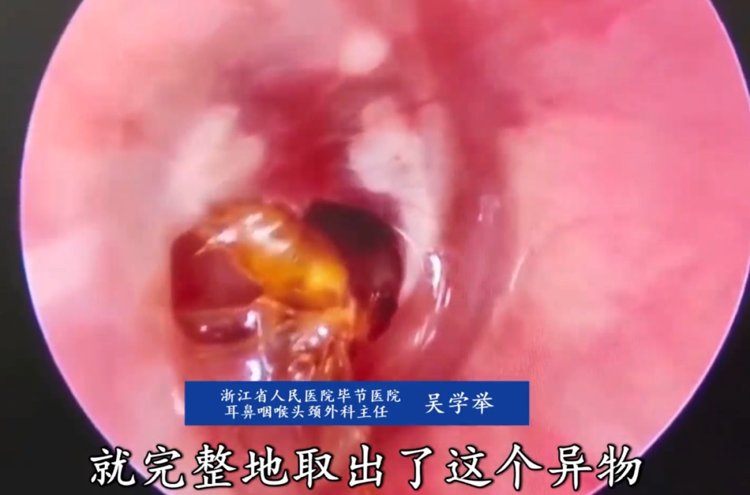 吓人！女子耳内突然钻心疼，医生取出四肢完整虫子……