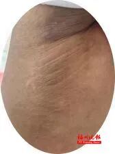孩子腋下发黑洗不净?医生提醒:这不是脏!得治 孩子腋下发黑洗不净?医生提醒:这不是脏!得治