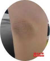 孩子腋下发黑洗不净?医生提醒:这不是脏!得治 孩子腋下发黑洗不净?医生提醒:这不是脏!得治