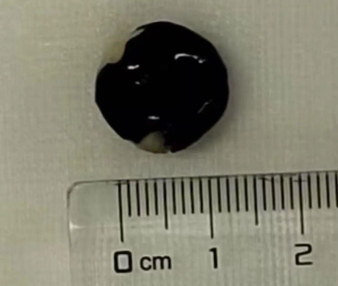 医生倒吸凉气！一颗下肚，女子竟进了ICU！已穿透食道并化脓…