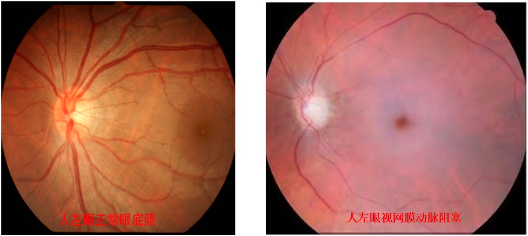 高三女生左眼突然失明!医生:已错过最佳抢救时机 高三女生左眼突然失明!医生:已错过最佳抢救时机
