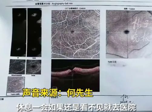 高三女生左眼突然失明!医生:已错过最佳抢救时机 高三女生左眼突然失明!医生:已错过最佳抢救时机