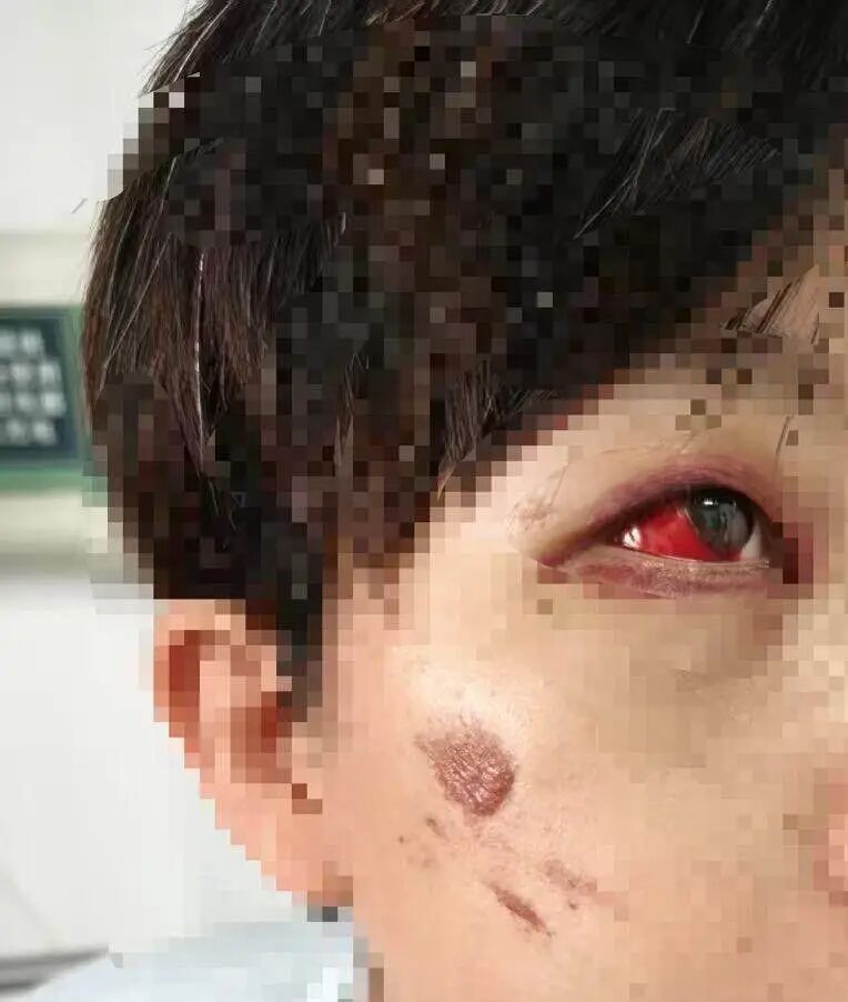 骑行中前轮突卡死，女用户被甩飞致面部骨折，共享单车平台：已跟进，会妥善处理