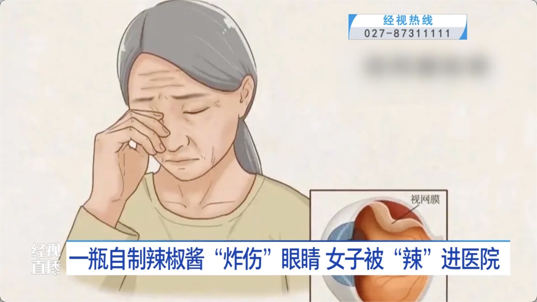 遭遇自制辣椒酱“喷溅袭击”,女子双眼灼伤险失明!医生紧急提醒 遭遇自制辣椒酱“喷溅袭击”,女子双眼灼伤险失明!医生紧急提醒