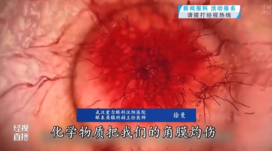 女子拧开自制辣椒酱，辣酱喷眼险失明！医生提醒这类情况要注意