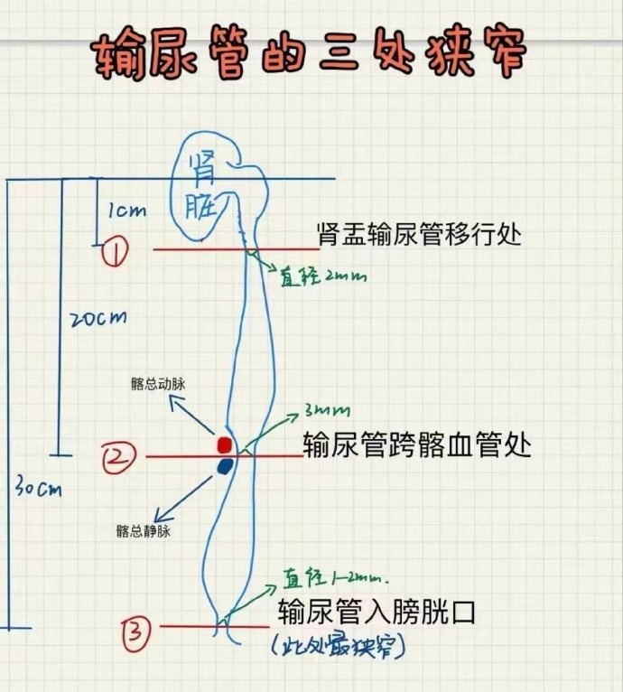 男子坐过山车后“甩出”肾结石？医生：尺寸是决定性因素