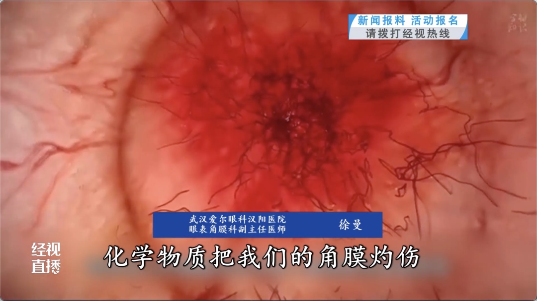 遭遇自制辣椒酱“喷溅袭击”,女子双眼灼伤险失明!医生紧急提醒 遭遇自制辣椒酱“喷溅袭击”,女子双眼灼伤险失明!医生紧急提醒