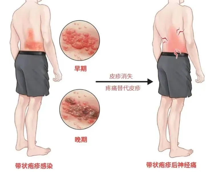 “最疼皮肤病”进入高发期！出现这些疼痛信号别大意