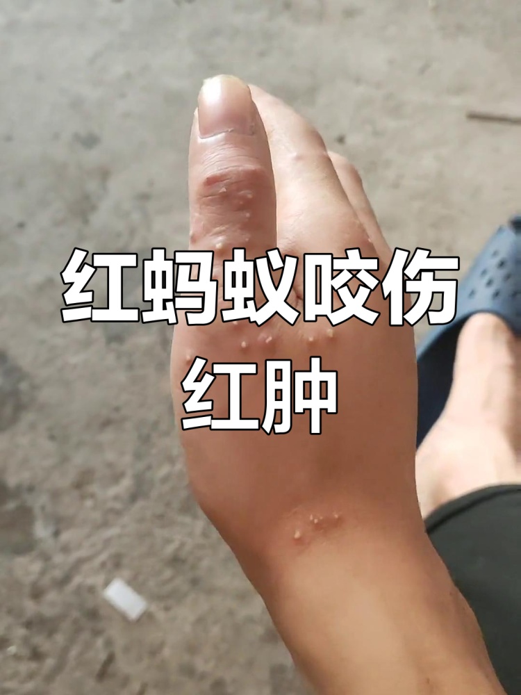 当心！广西已有多人被咬伤，还有人被送进ICU抢救，花了20多万元！